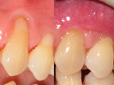 Gum Graft Before and after